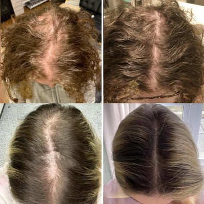 VitalesWachstum™ Haarwuchs-Öl