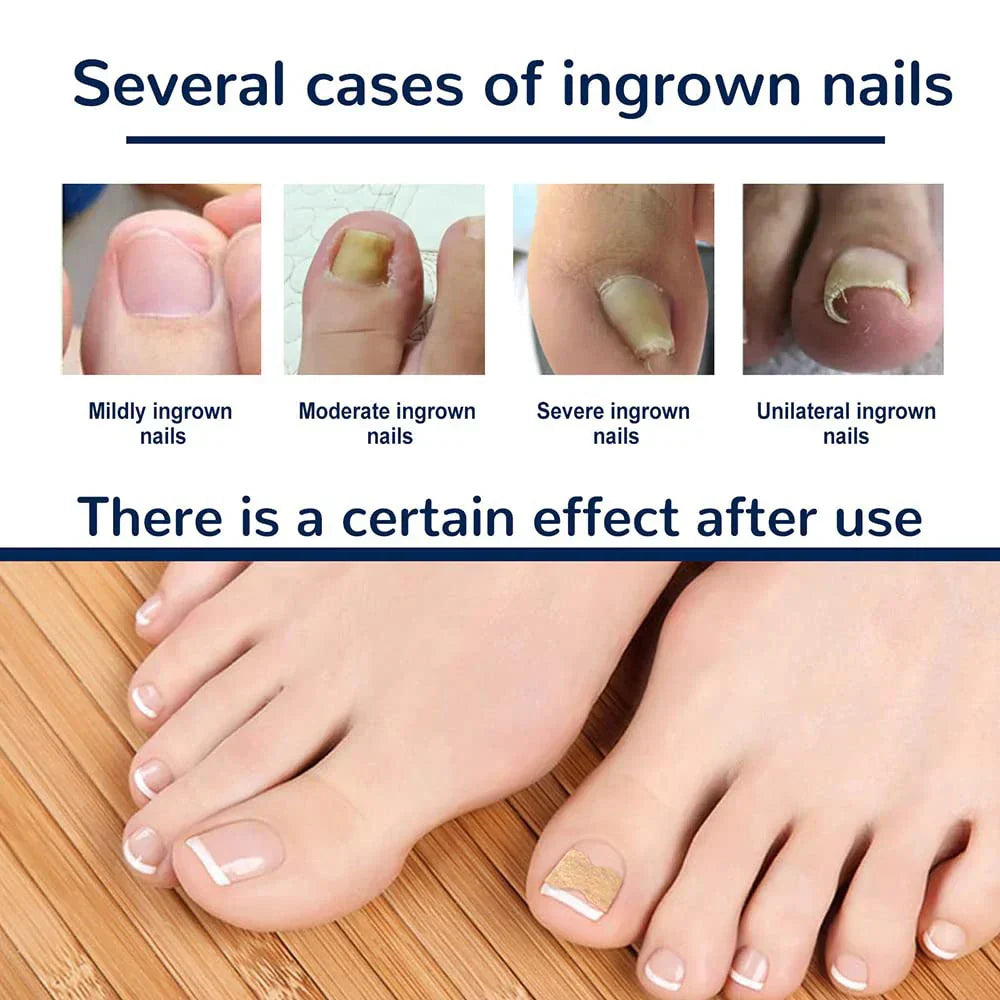NägelNachbessern™ Pflegeaufkleber für Nagelkorrekturen