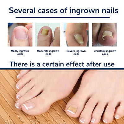 NägelNachbessern™ Pflegeaufkleber für Nagelkorrekturen