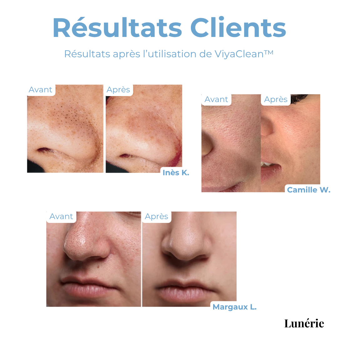 5+5 Gratis | Anti-Mitesser Serum | Tiefenreinigung der Poren | Mit Salicylsäure & Teebaum-Extrakt