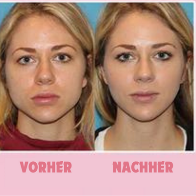 GesichtForm™ Definierende Kieferlinie Optimierung