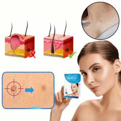 Warzenentferner WarzenWeg | Schmerzfrei & Effektiv | Hautschonende Behandlung | Präzise Anwendung