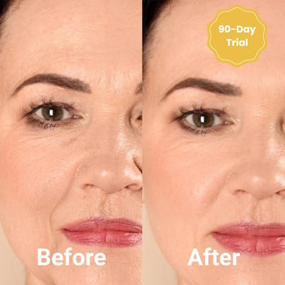 DermaFaden™ Vollständiges Kollagen-Fadenlifting-Kit