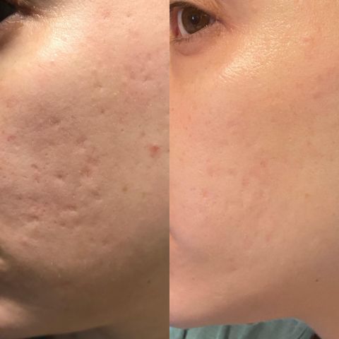 Wiederverwendbare Anti-Falten-Patches | Schlafpads für Gesicht & Stirn | Glättet Linien & Falten über Nacht