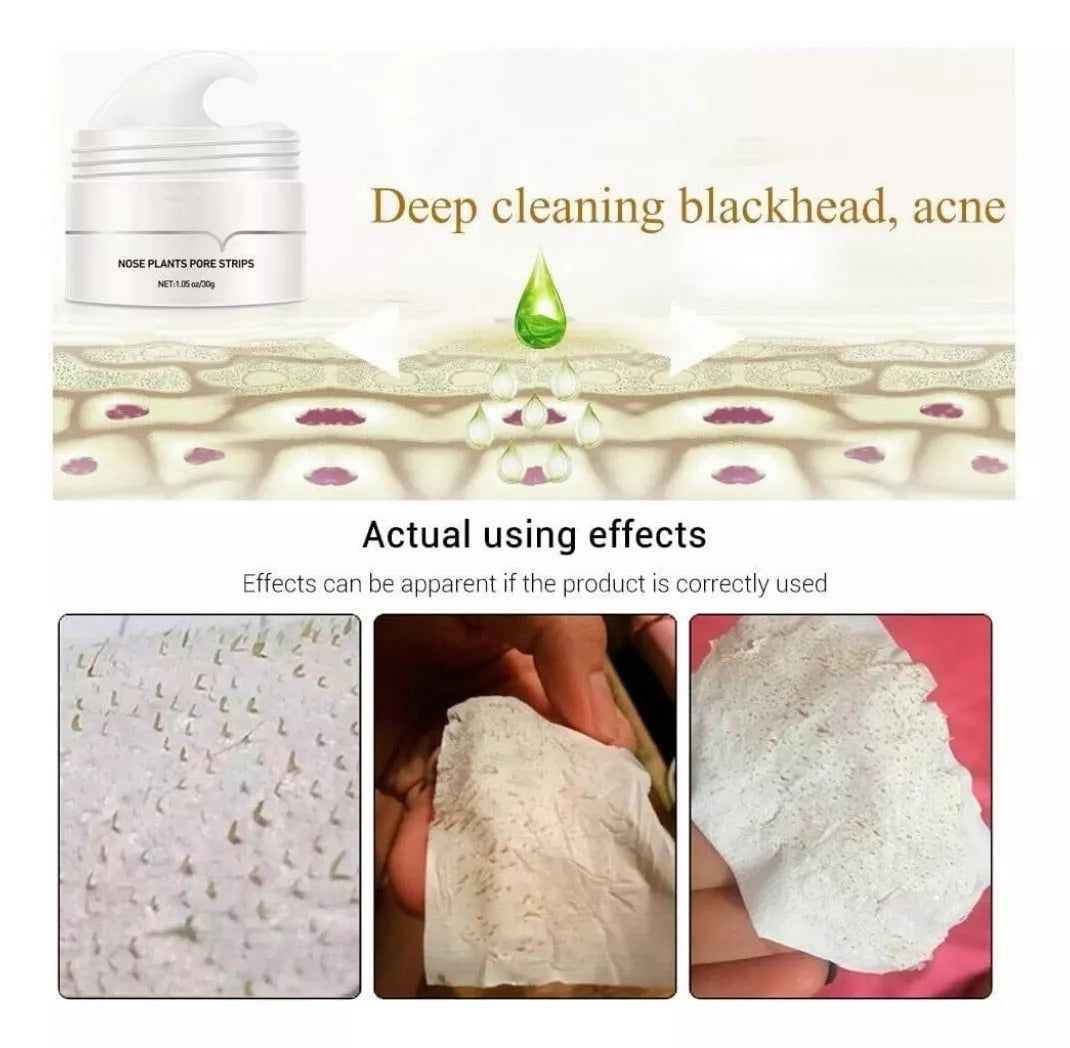 1+1 Gratis | Porenreinigungspflaster | Mitesserentferner mit Aktivkohle & Aloe Vera