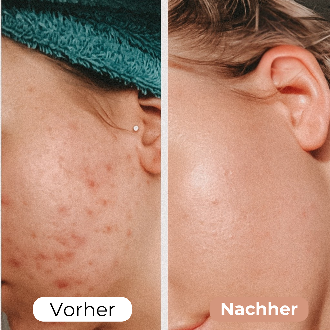 FaltenBand™ Feine Linien glätten